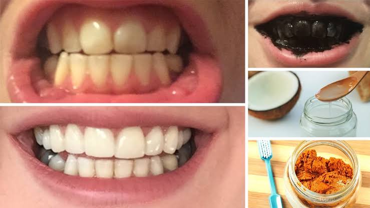 How to whiten yellow teeth with Home Remedies